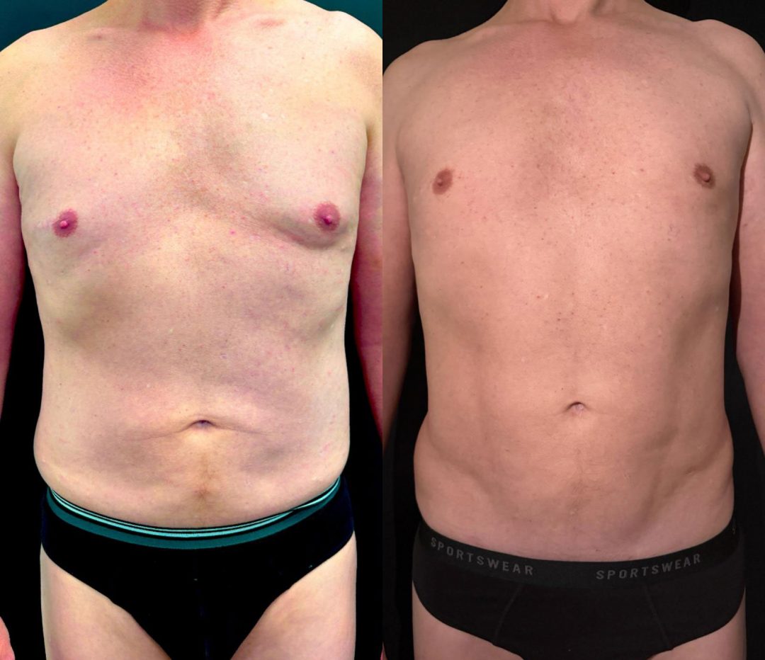 Vorher- Nachher-Vergleich einer Fettabsaugung am Bauch mit Muskeldefinition bei männlichem Patienten