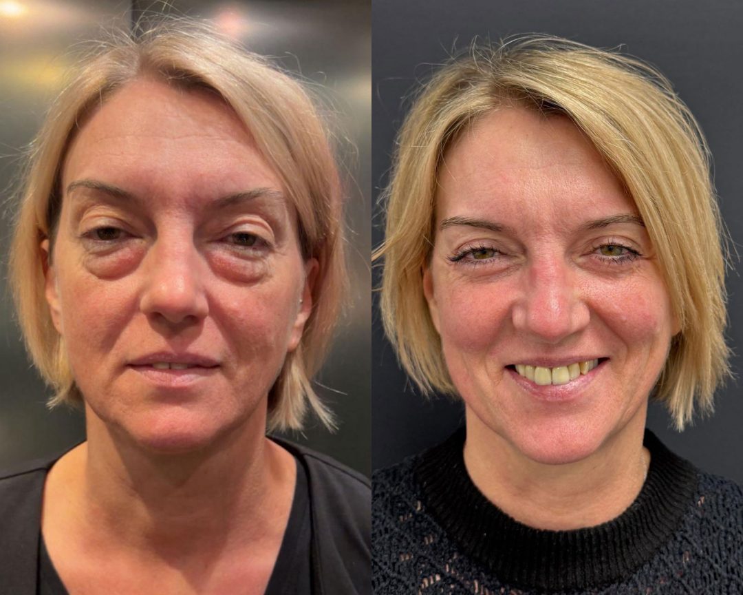 Vorher- Nachher-Vergleich einer Ober- und Unterlid-Straffung