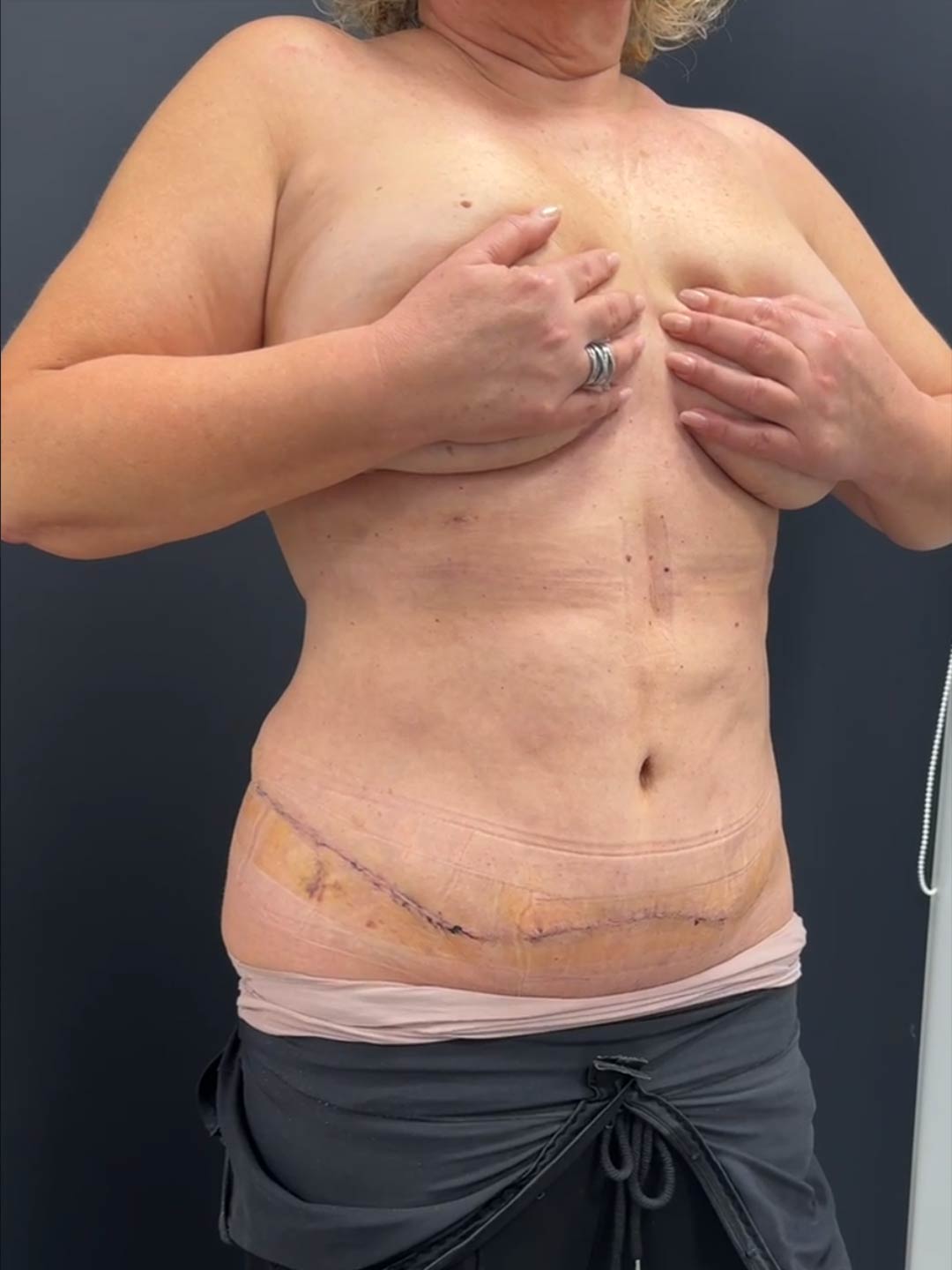 Bauchdeckenstraffung Vorher-Nachher-Vergleich - 3 Wochen nach OP