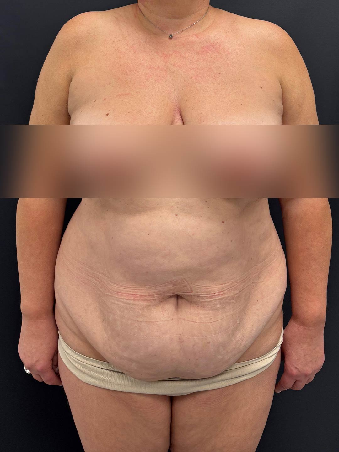 Bauchdeckenstraffung Vorher-Nachher-Vergleich - vor der OP