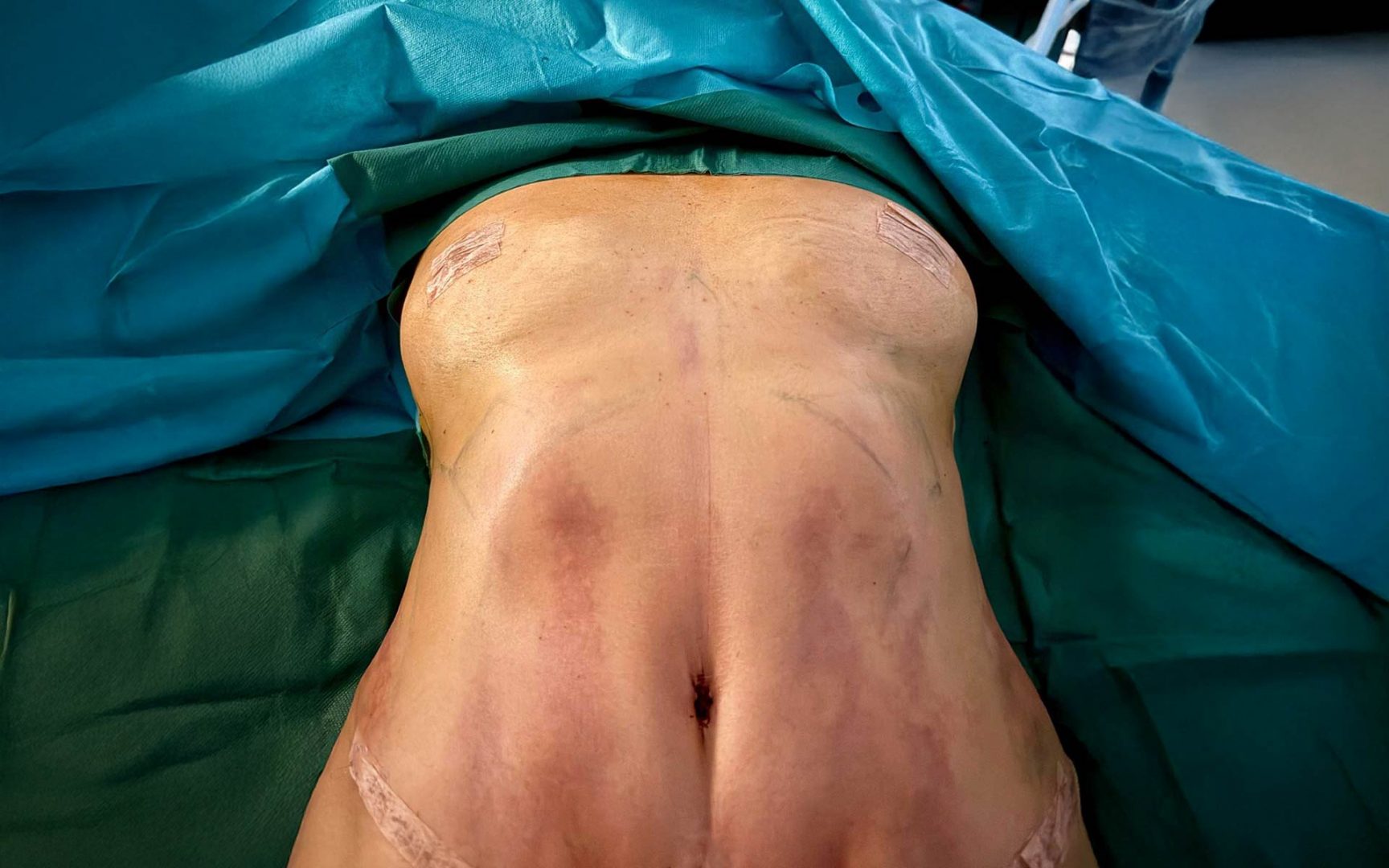 Ergebnis einer Bauchdeckenstraffung (Abdominoplastik) Behandlung bei revitCells in Soest